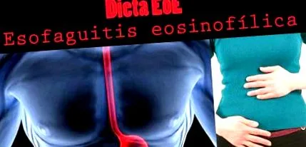 esophaguitis