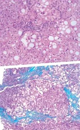 steatohepatitis