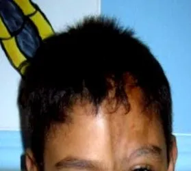 szkleroderma