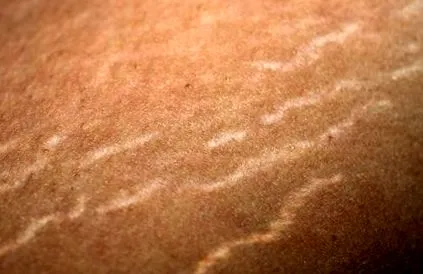 Stretch Marks