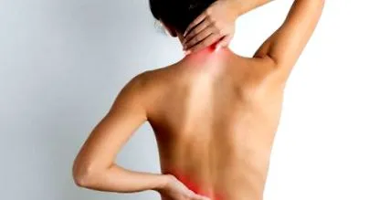 spondylitis