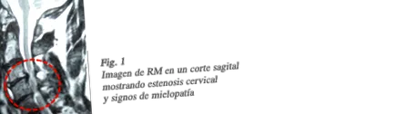 stenosis