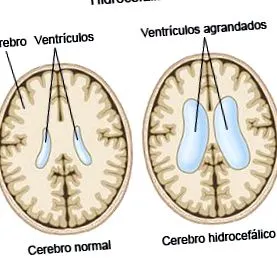 hydrocephalus