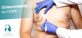 gynecomastia