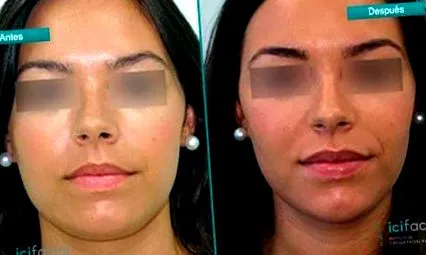 icifacial