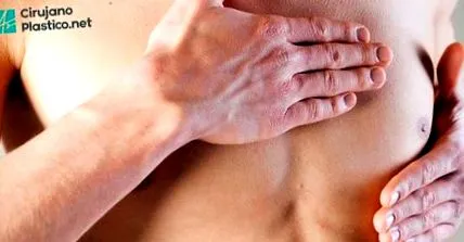gynecomastia