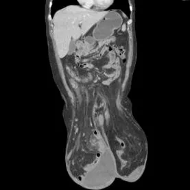 inguinalis