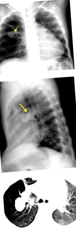 pulmonary