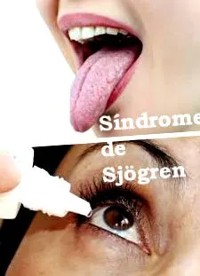 Синдром Sjogren
