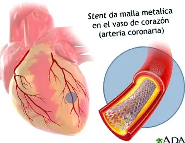 stentelése