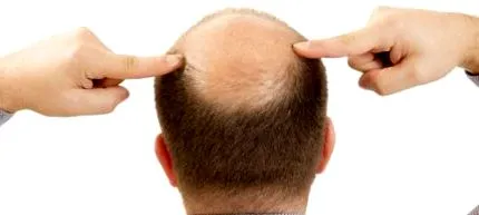 alopecia