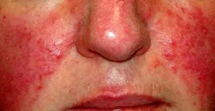 rosacea