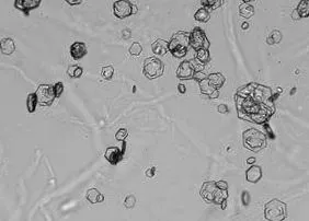 cystinuria