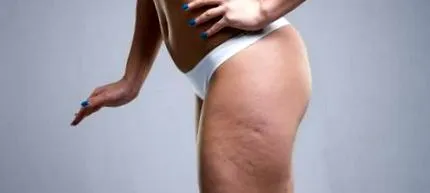 cellulit