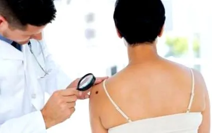 melanomát
