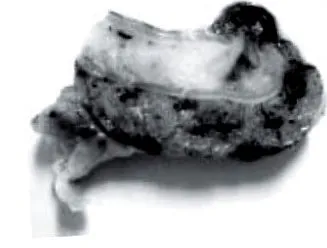 appendectomia