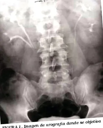 pyeloureteralis