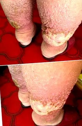 elephantiasis verrucosa