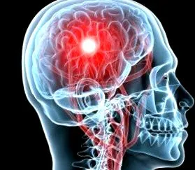 stroke