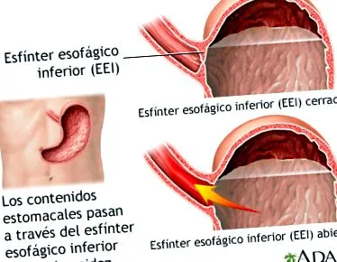 gastroesophagealis