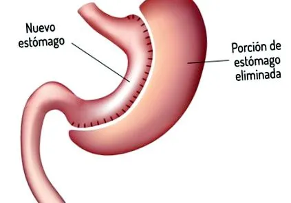 elhízás cukorbetegség