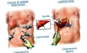cholecystectomia