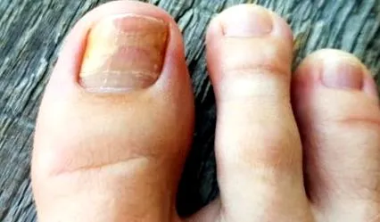 onychomycosis