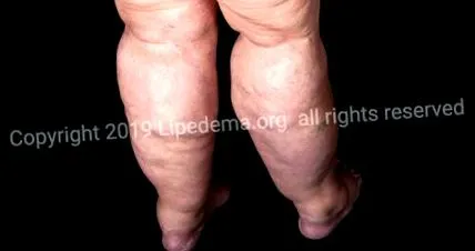 lipedema