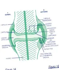 térd osteoarthritisében