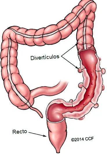 divertikuláris