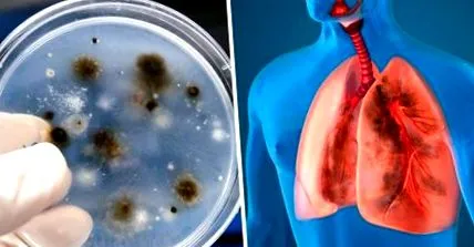 aspergillosis