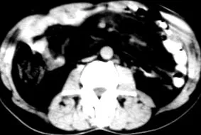 panniculitis