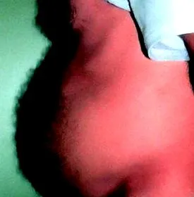 lipodystrophia