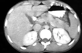 pancreatitis
