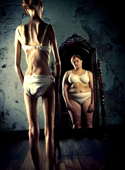 anorexia