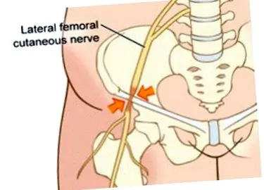 meralgia