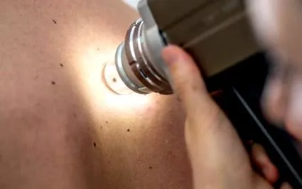 keratosis