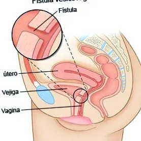 sicovaginal