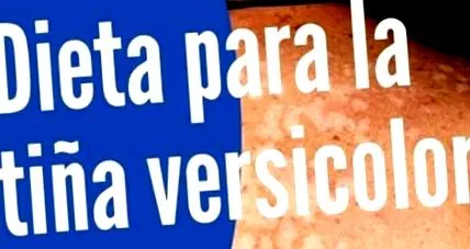 tinea