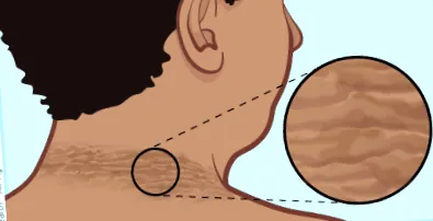 acanthosis acanthosis nigricans
