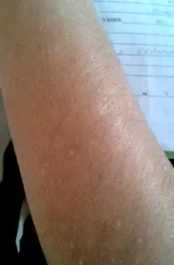 alopecia