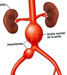 aorta aneurysma