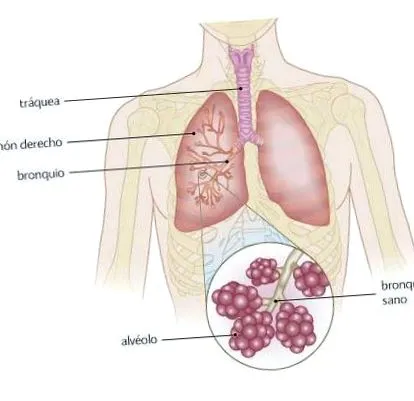 bronchopneumonia