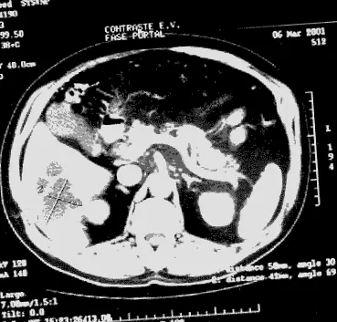 cholangiocarcinoma