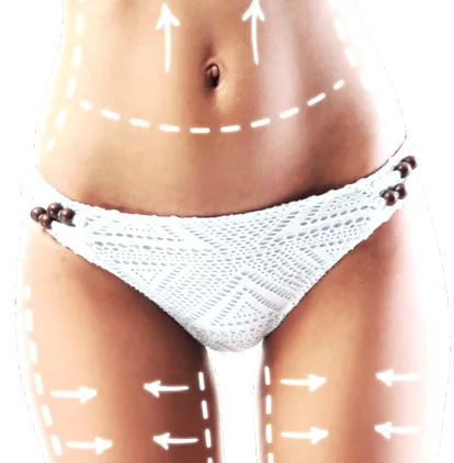 lipedema