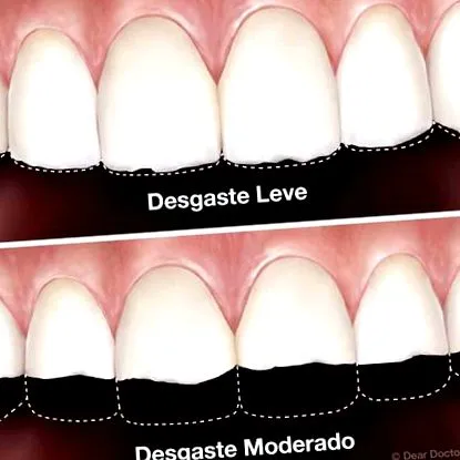 desgaste