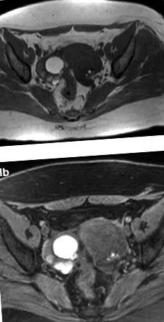 endometriosis