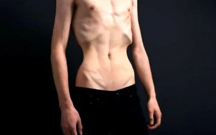 anorexia