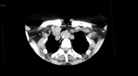 hemangioma