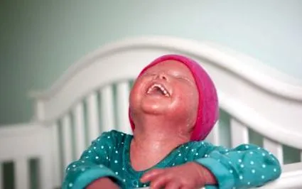 ichthyosis